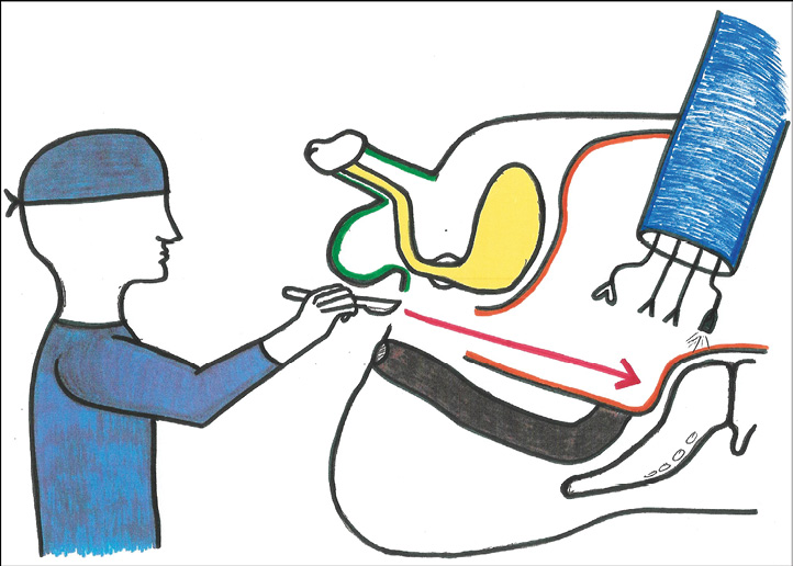 Robotics The Role Of Robotic Assisted Peritoneal Flap Augmentation In Gender Affirming 3090